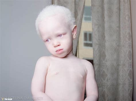 albino insanların özellikleri